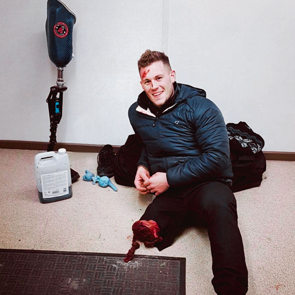 AMPLIFE SUPPORTER ACTING WITH A SEVERED LIMB AND PROSTHETIC LIMB IN BACKGROUND